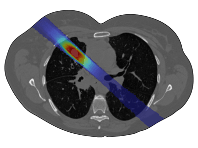 Hadron Therapy Simulation App for Lung Cancer: An Educational Tool for ...