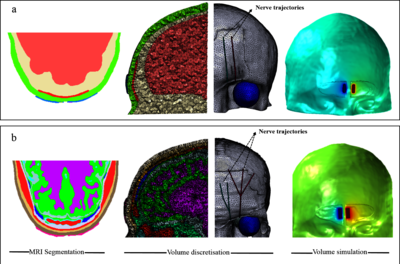 Computational Study on Transcutaneous Frontal Nerve Stimulation: ...