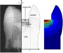 Temperature Excursions at the Pulp-Dentin Junction during the Curing of ...